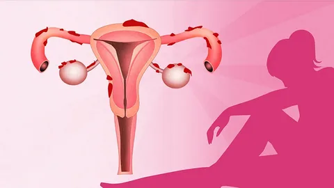بطانة الرحم المهاجرة